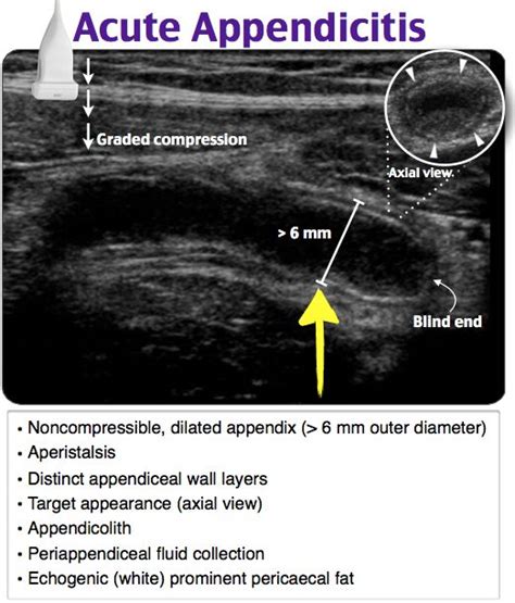 Acute Appendicitis | Medical ultrasound, Ultrasound technician ...