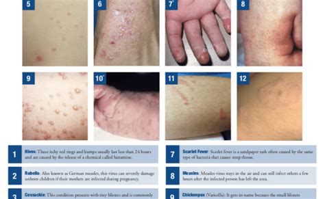 8 Common Types Of Rashes Types Of Rashes Common Skin Rashes Types ...