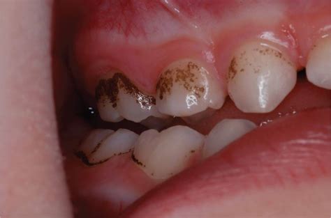 Black Stains On Teeth Near Gums Teethwalls 9DA