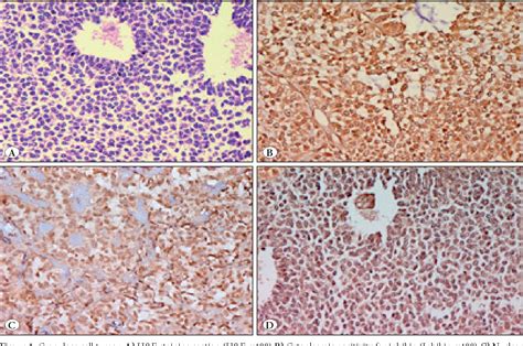 Figure 1 From Correlation Of Foxl2 With Inhibin And Calretinin In The