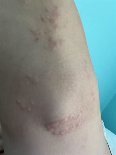 Why Are There Weird Bumps On My Elbow at Maria Baum blog