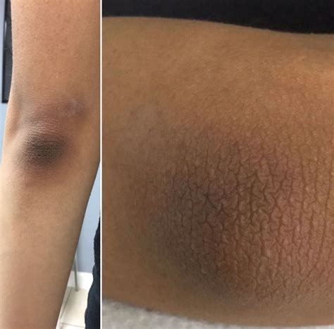 Dark Spots On Elbows Discolouration Skin How To Get