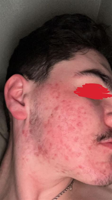 Day 1 Vs Day 30 40mg Daily R Accutane