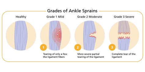 How To Treat A Sprained Ankle Sterosport