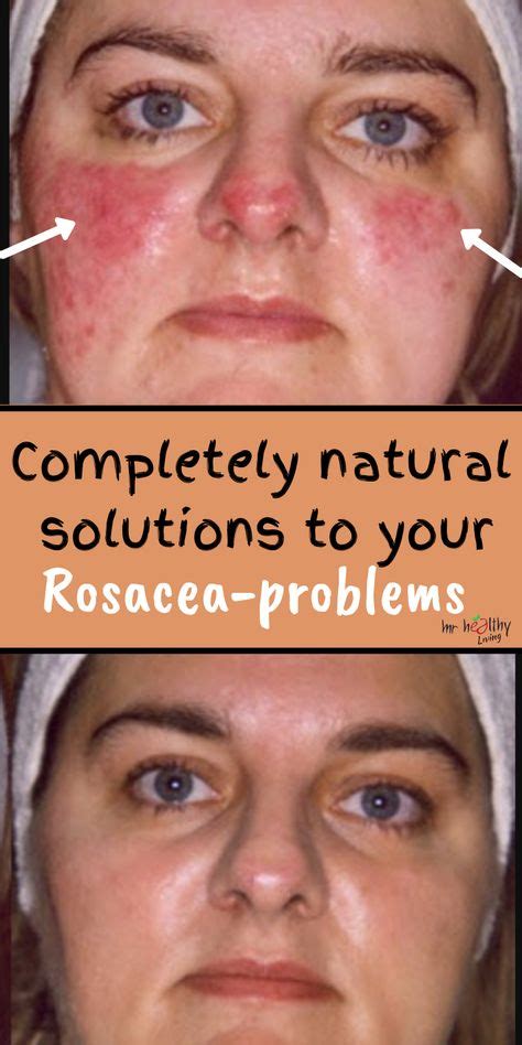 Rosacea Rosacea Remedies Rosacea Remedies Essential Oils Rosacea