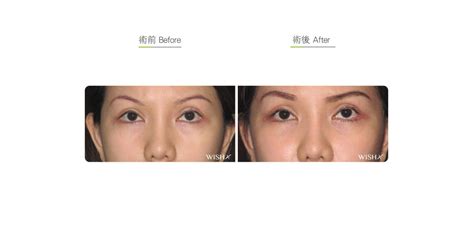 Lateral Canthopexy Before And After