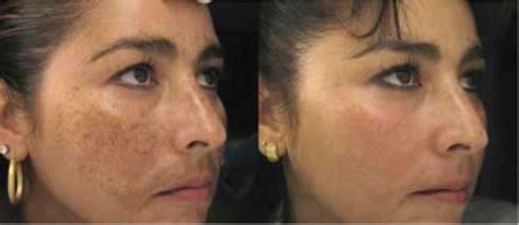 Tratamiento De Manchas Con Luz Pulsada Ipl Esteticistas