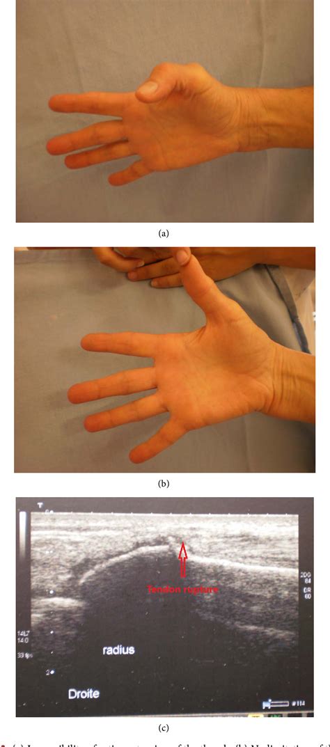 Figure 2 From Extensor Pollicis Longus Tendon Rupture After Non