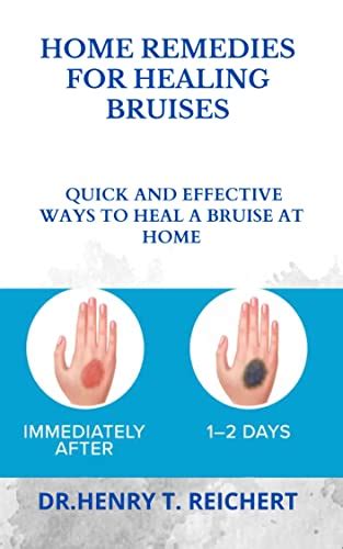 HOME REMEDIES FOR HEALING BRUISES: QUICK AND EFFECTIVE WAYS TO HEAL A ...