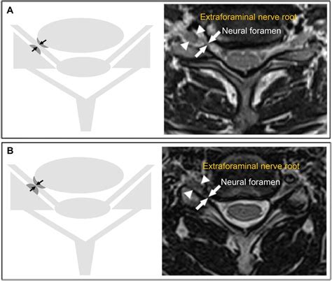 Neural Foramen Mri