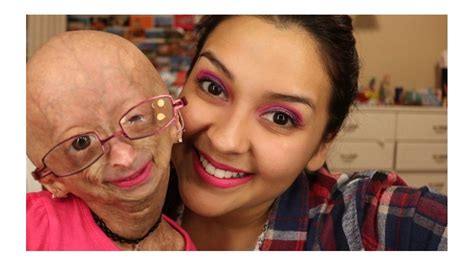 Adalia Rose La Pequeña Con Envejecimiento Prematuro Que Conquistó Youtube