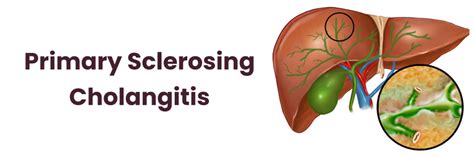 Primary Sclerosing Cholangitis Symptoms And Treatment Guide