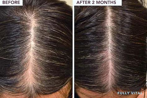 Derma Roller Before and After: Unlocking the Potential for Hair Growth ...