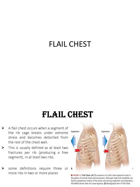 Flail Chest | PDF | Medical Emergencies | Pulmonology