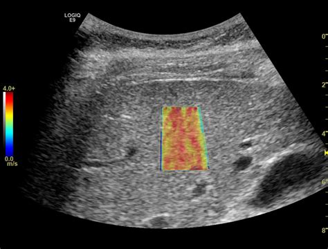 A Better Evaluation Of Liver Fibrosis Radiology Report