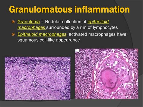 Ppt Granulomatous Inflammation Powerpoint Presentation Free Download Id 2374733