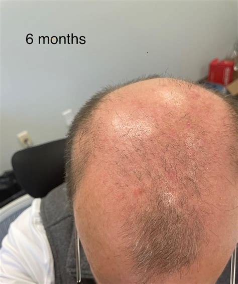 6 Months On Hims Topical Minoxidal And Finasteride Combination And