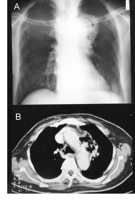 Successful Treatment Of Salmonella Mycotic Aneurysm Of The Descending