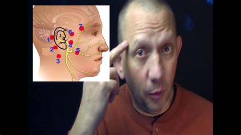 Bells Palsy And The Electric Acupuncture Pen Youtube