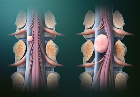 Spinal Tumor Endospine Hospital