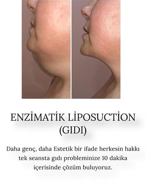 Gıdı Bölgesi Enzimatik Liposuction Niobe