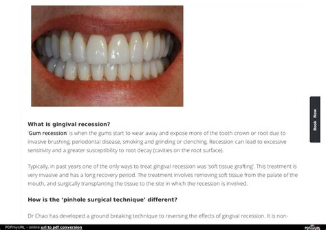 PPT - Best Gingival Recession Treatment Canada PowerPoint Presentation