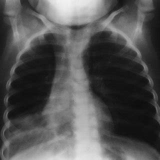 chest radiograph  case  showing   lobe opacification