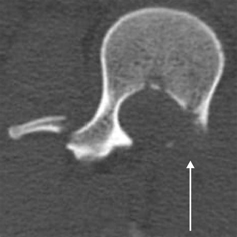 Pedicle Fracture