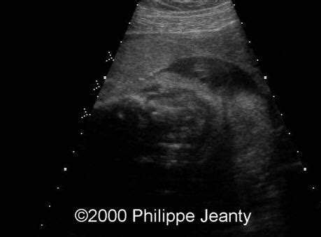 📃 Succenturiate & bilobate placenta