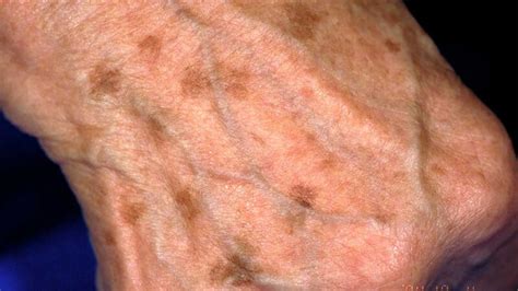 Liver Spots Causes Symptoms Treatments And More