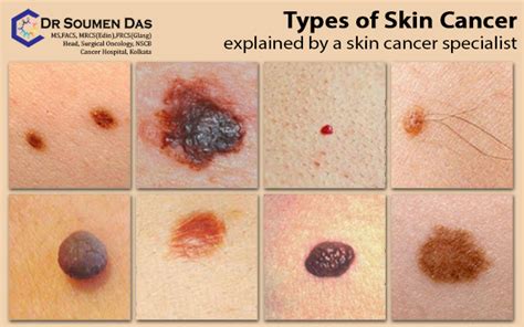 Different Types Of Skin Cancer Spots Nbkomputer