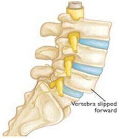 Table Of Content:What is Anterolisthesis?What is Vertebra?Causes of ...