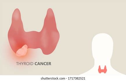 Thyroid Cancer Tumor Inside Human Throat Stock Illustration 1717382521 ...