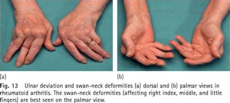 Rheumatoid Arthritis Ulnar Deviation Caption Update