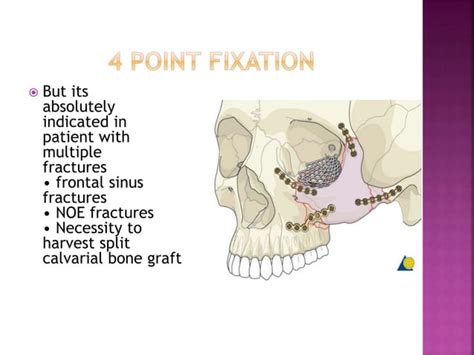 Zygomatic Complex Fracture Ppt