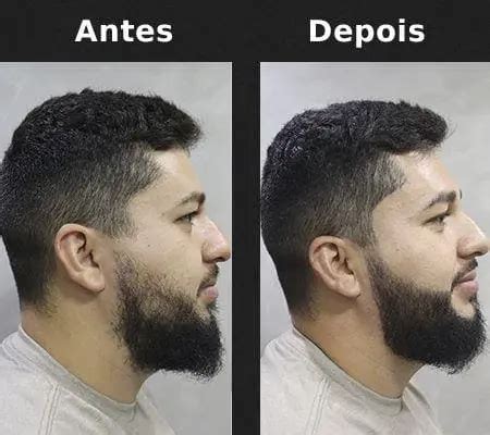 Preenchedor De Falhas Na Barba