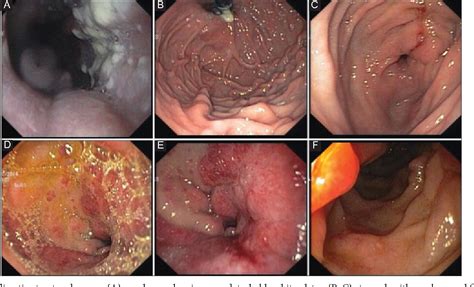 Figure 2 From A Rare Case Of Burkitts Lymphoma Of The Duodenal Bulb