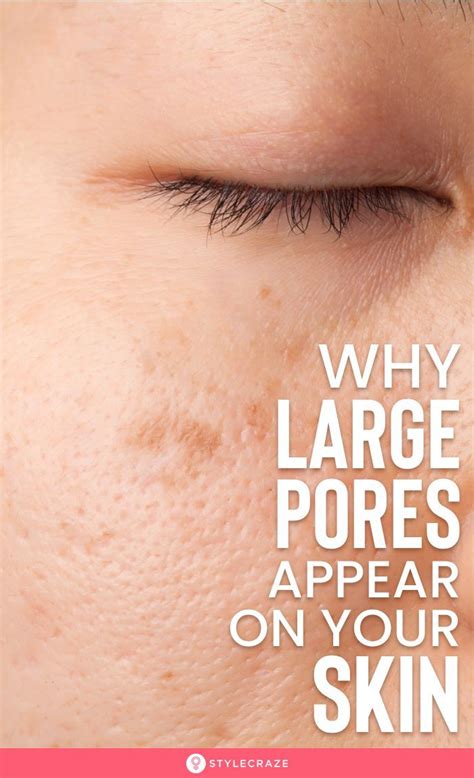 Why Large Pores Appear And How To Get Rid Of Them Artofit