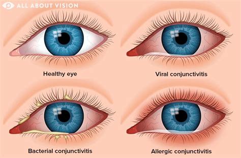 Conjunctivitis Unmasked Understanding The Common Eye Flu