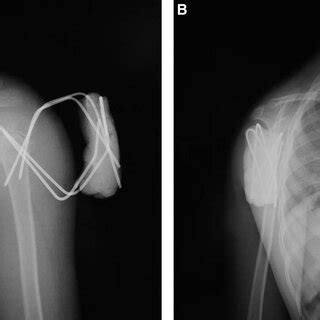 A 43 Year Old Patient With Neer 4 Part Proximal Humeral Fracture