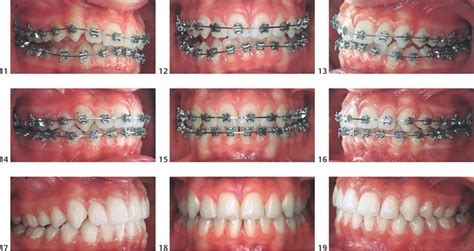 Concepts Of Retention Pocket Dentistry