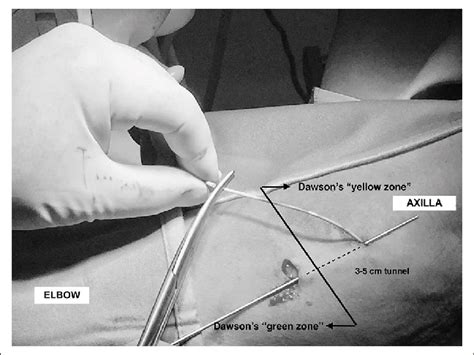 Picc Port Insertion Technique Venous Access In The Zim Technique