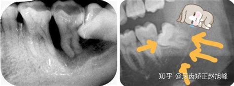 怎么知道自己长了智齿？又为什么长不出来？ 知乎