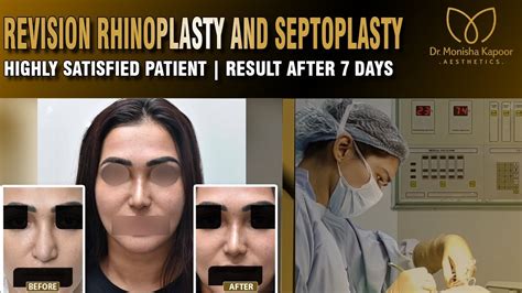 Revision Rhinoplasty And Septoplasty Result By Dr Monisha Kapoor Delhi