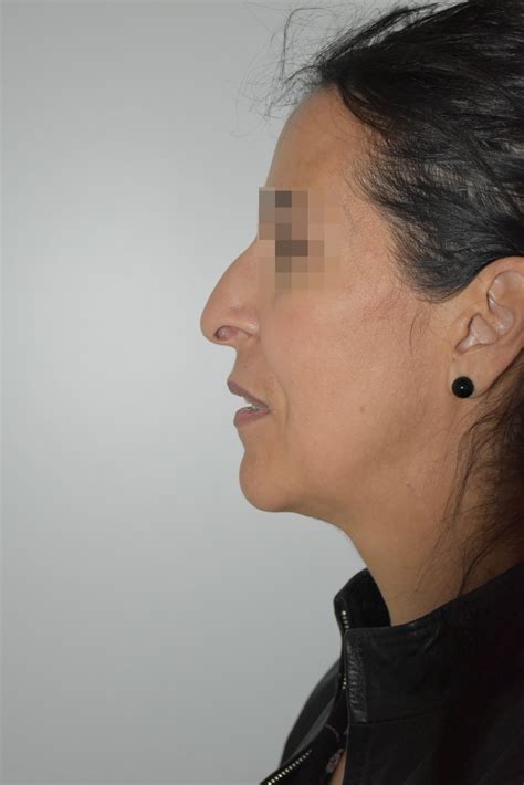 Avant Apr S Rhinoplastie G Nioplastie Du Docteur Martin