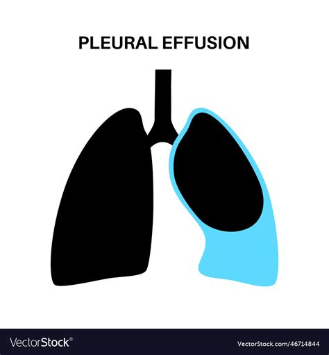 Pleural Effusion Poster Royalty Free Vector Image