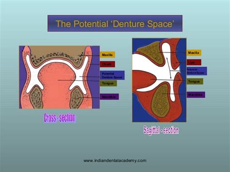 Concept Of Neutral Zone Dental Seminars