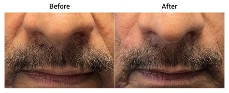 Nasolabial Folds Filler Before And After Gallery Melbourne Fl And Tampa Fl Indigo Dermatology