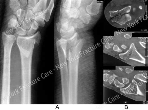 Wrist Fracture New York Fracture Care