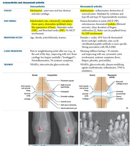 Osteoarthritis Vs Rheumatoid Arthritis Flashcards Quizlet